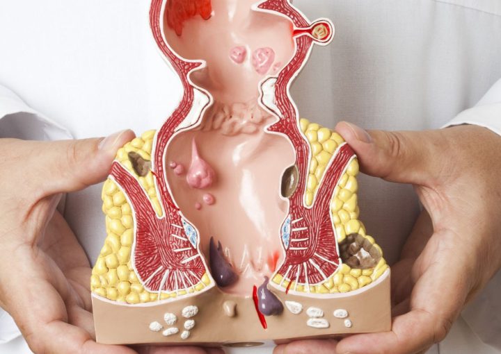 علاج البواسير الخارجية المنتفخة