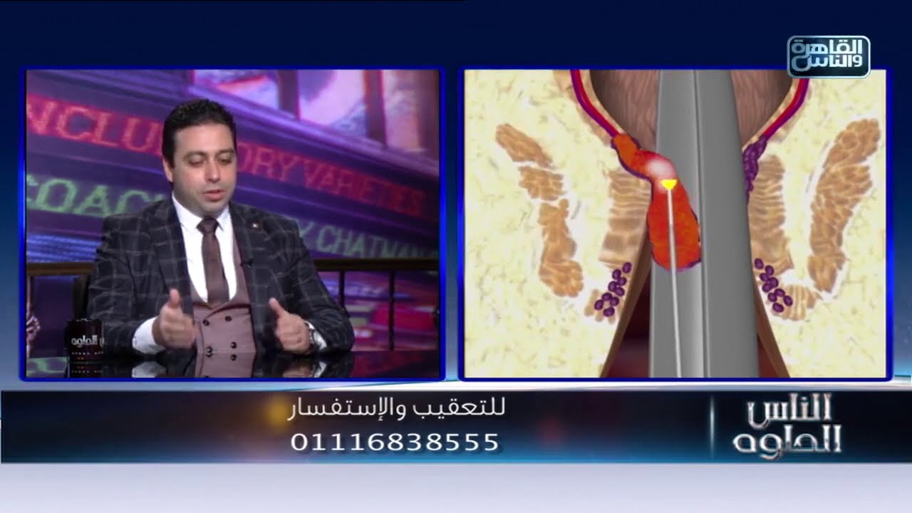 أحدث طرق علاج البواسير والشرخ الشرجي