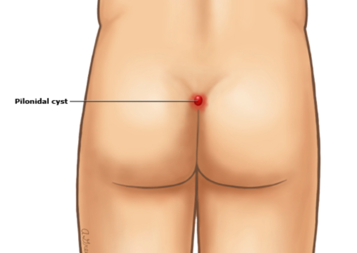 اعراض الناسور العصعصي