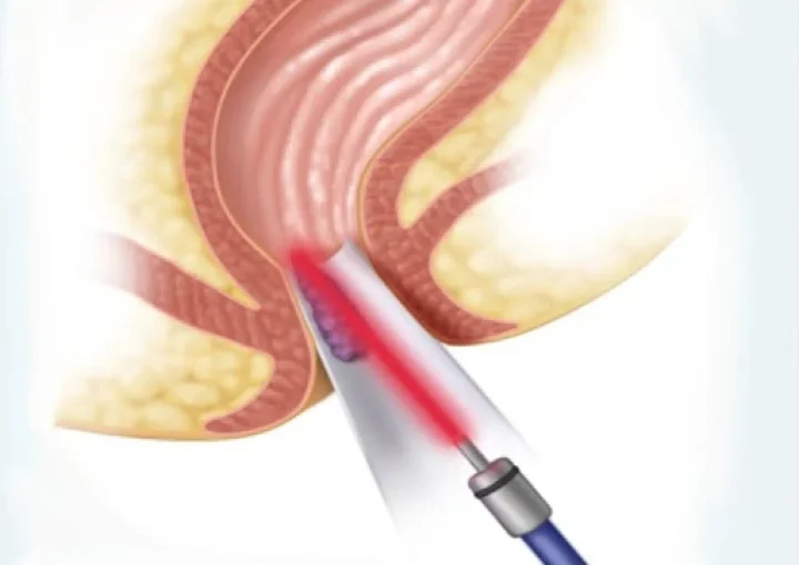 عملية البواسير بالليزر