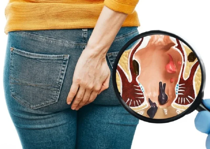 البواسير الخارجية عند النساء