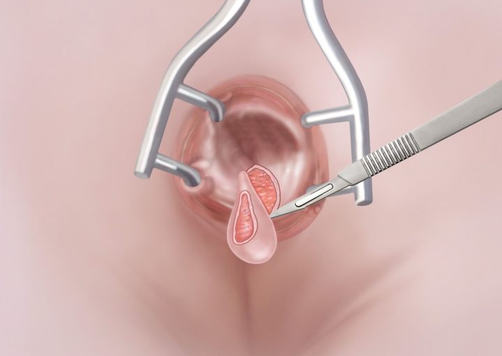 تكلفة عملية الشرخ الشرجي
