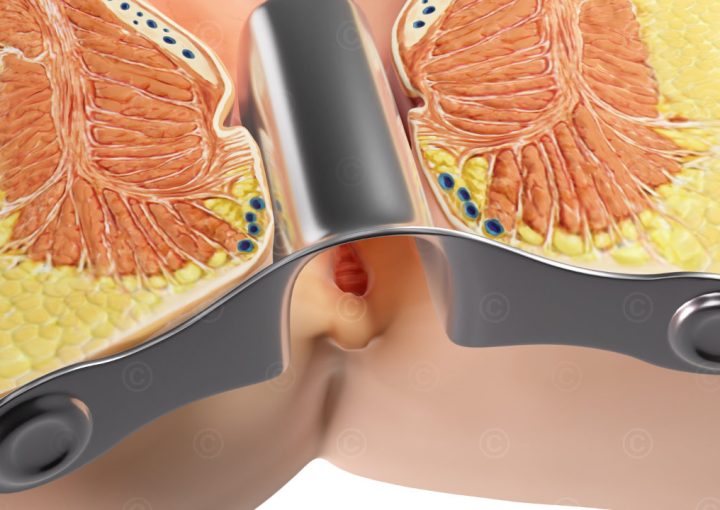 سعر عملية الشرخ بالليزر