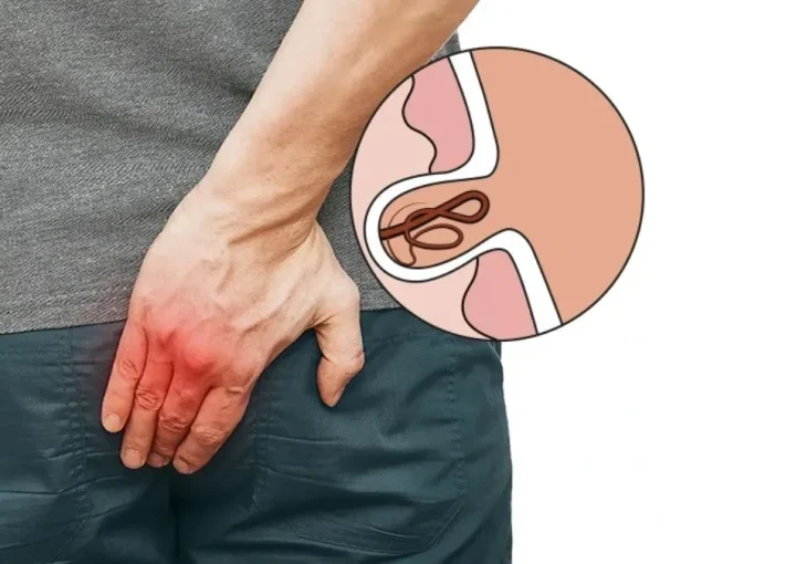 طرق علاج الناسور العصعصي