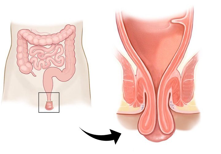علاج السقوط الشرجي
