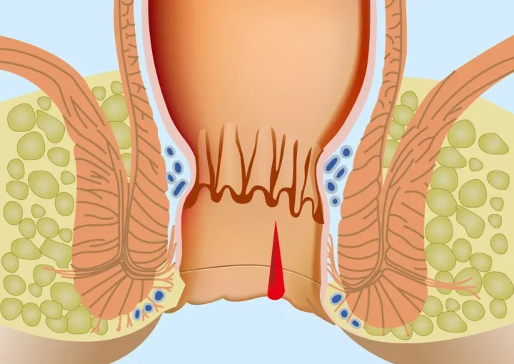 علاج الشرخ الشرجي