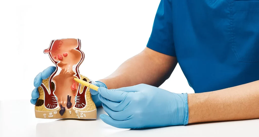 علاج الناسور بدون جراحة