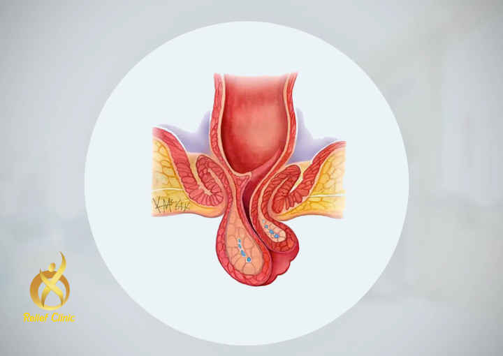 علاج تدلي المستقيم بدون جراحة
