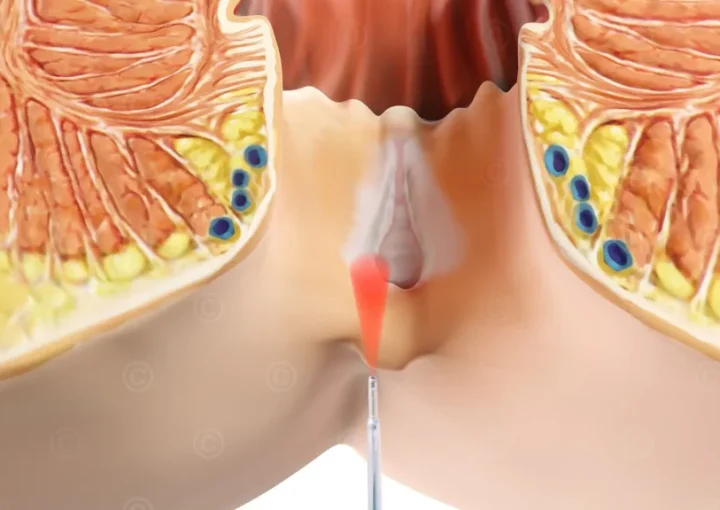 كم تستغرق عملية الشرخ