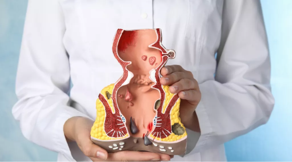 أفضل دكتور للتخلص من البواسير نهائيًا