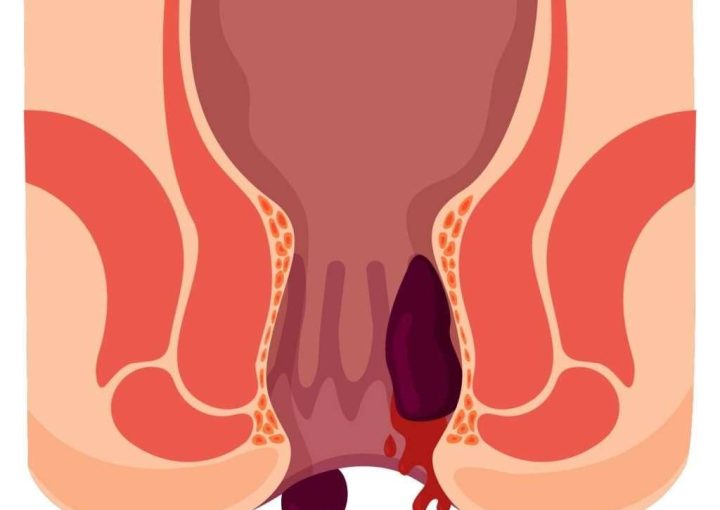 البواسير الداخلية من الدرجة الاولى