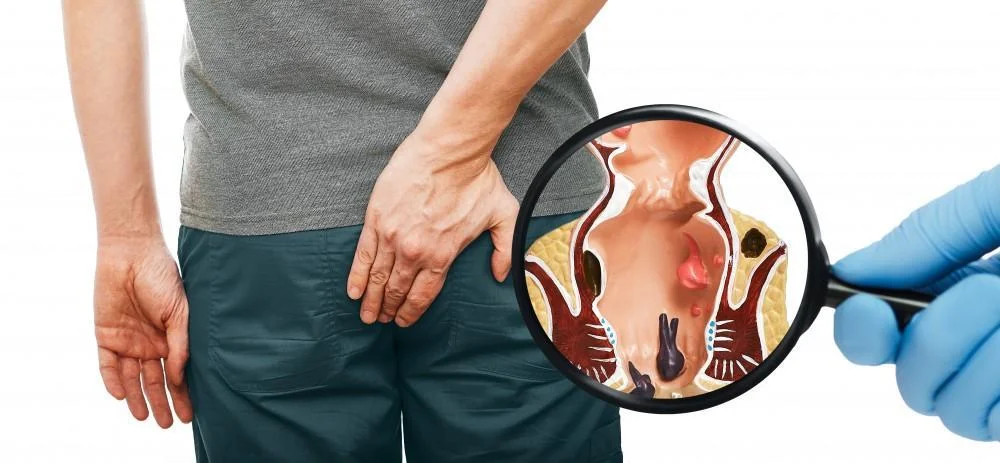 أعراض البواسير الداخلية والخارجية