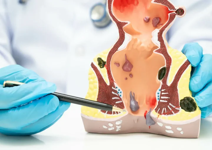 أعراض فشل عملية البواسير