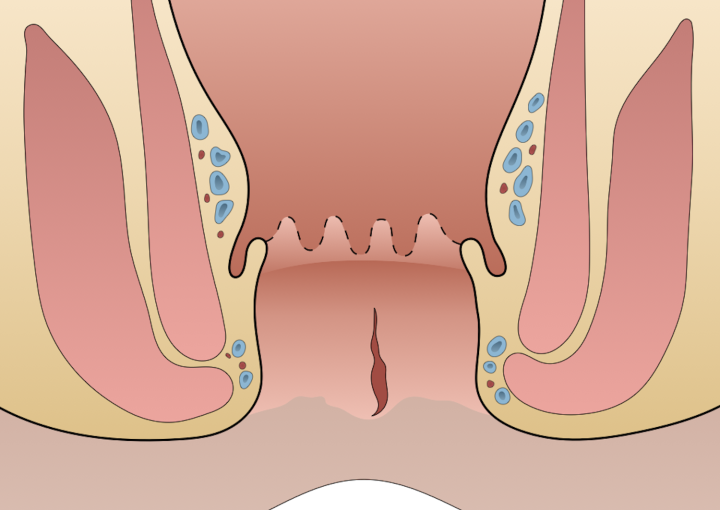 كيفية علاج الشرخ الشرجى نهائياً