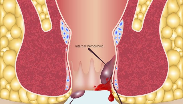 اعراض البواسير الداخلية