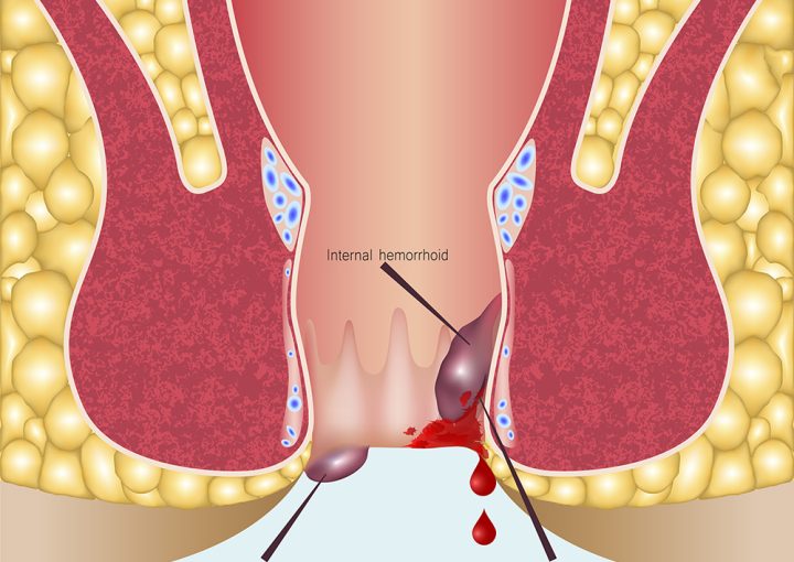 اعراض البواسير الداخلية