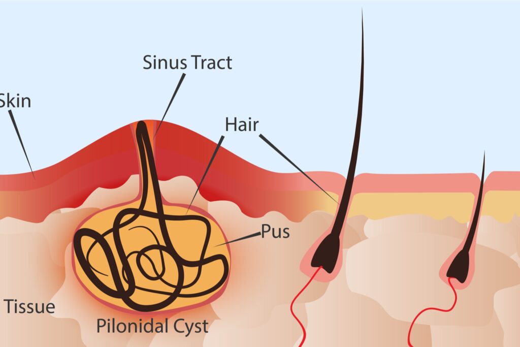 أهمية الكشف المبكر عن الناسور وعلاجه