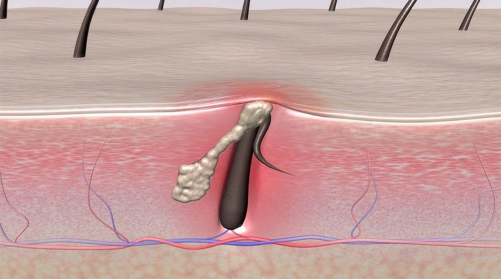  تكلفة عملية الناسور بالليزر في مصر 
