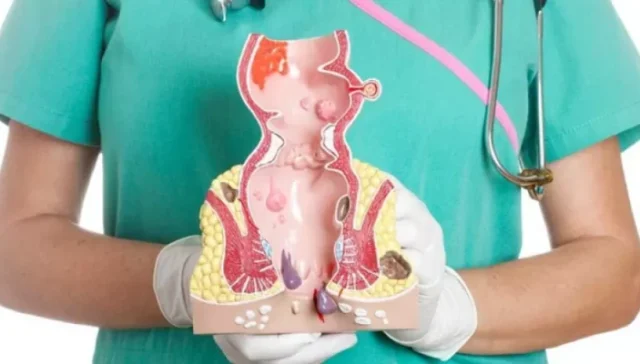 افضل علاج للشق الشرجي