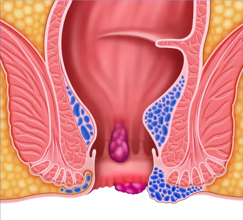 ما هي أنواع الشرخ الشرجي؟