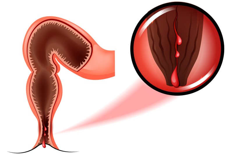 مضاعفات الشق الشرجي