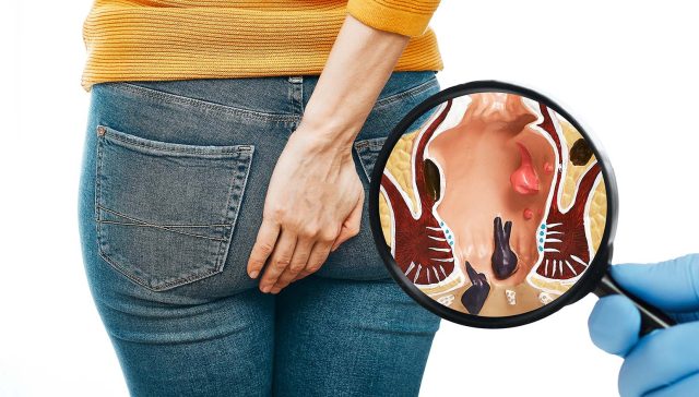 أفضل دكتور بواسير في القاهرة