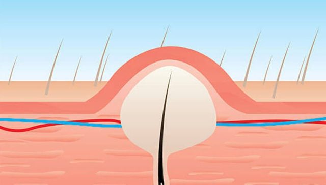 تجربتي مع الناسور العصعصي
