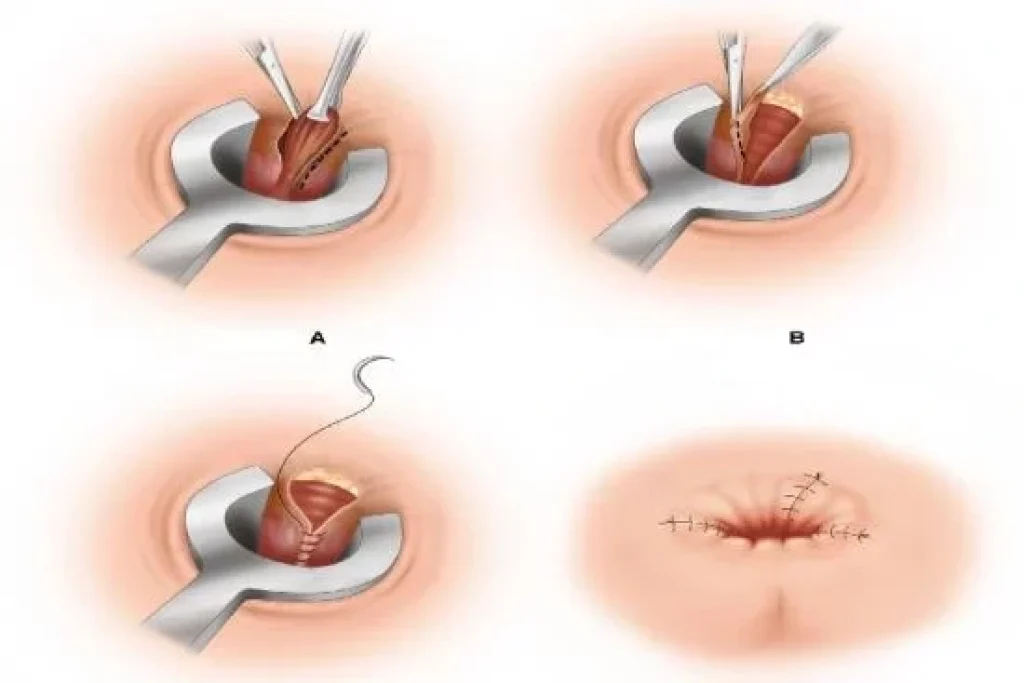 مميزات عملية البواسير بالليزر
