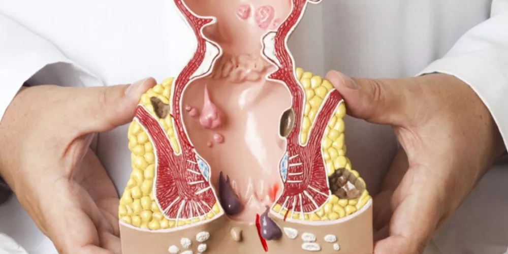 تجربتي مع عملية البواسير بالليزر مصر في مركز ريليف كلينك