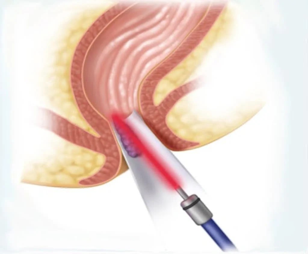 تكلفة عملية البواسير