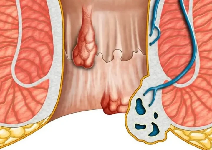 علاج الشرخ المزمن