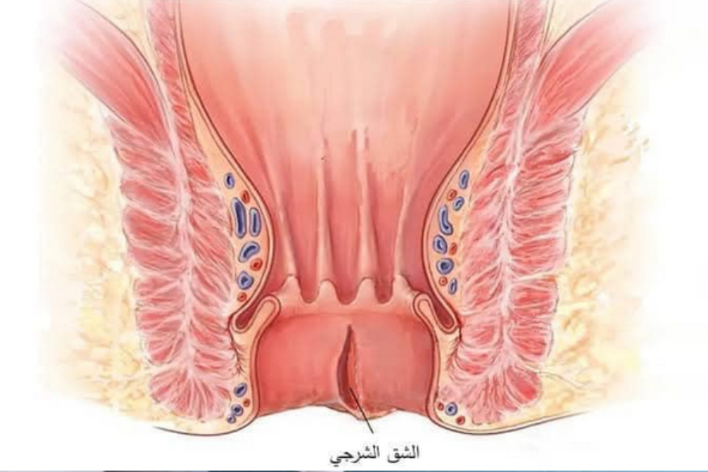الفرق بين البواسير والشرخ