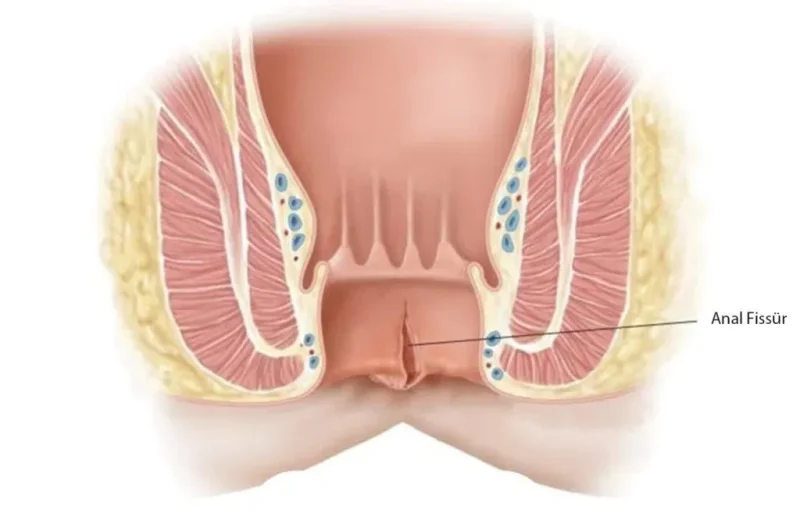 أسباب الشق الشرجي