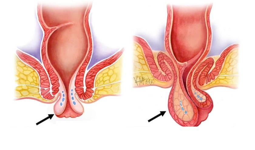 هبوط المستقيم بالصور