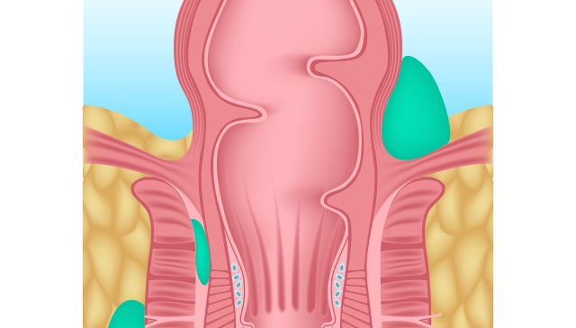 علاج الخراج الشرجي