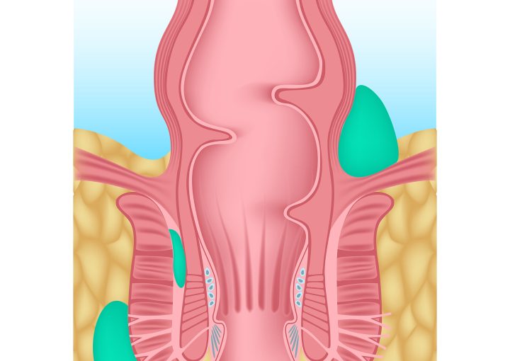 علاج الخراج الشرجي
