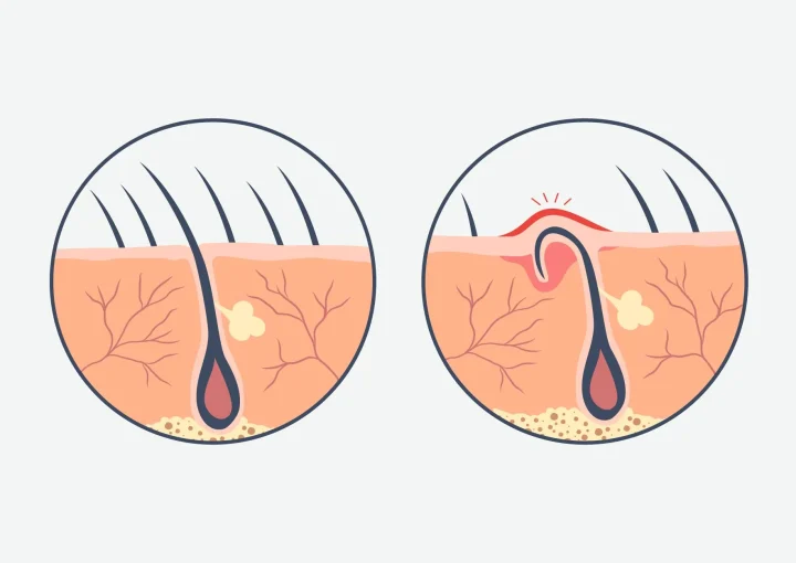 مضاعفات ما بعد عملية الناسور العصعصي
