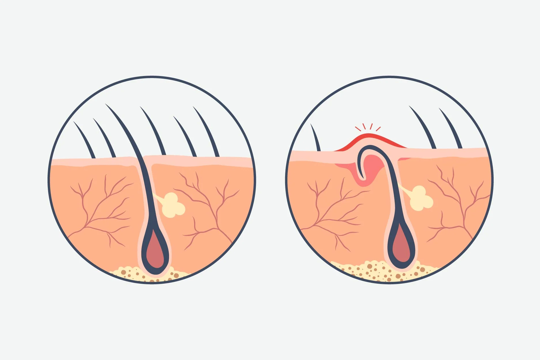 مضاعفات ما بعد عملية الناسور العصعصي