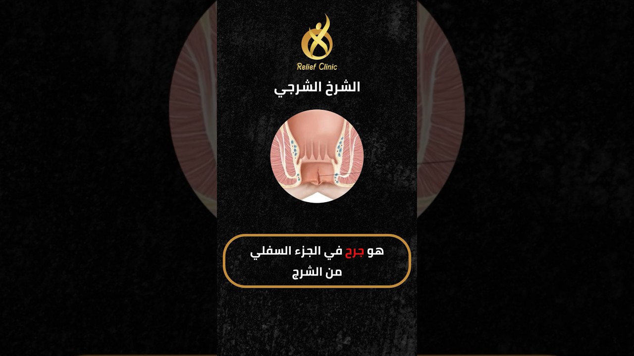 أسباب حدوث الشرخ الشرجي وعلاجه