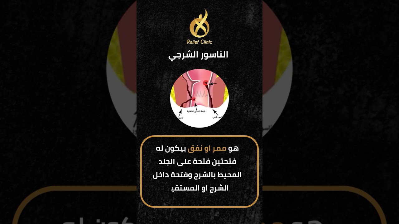 تعريف الناسور الشرجي وأسبابه