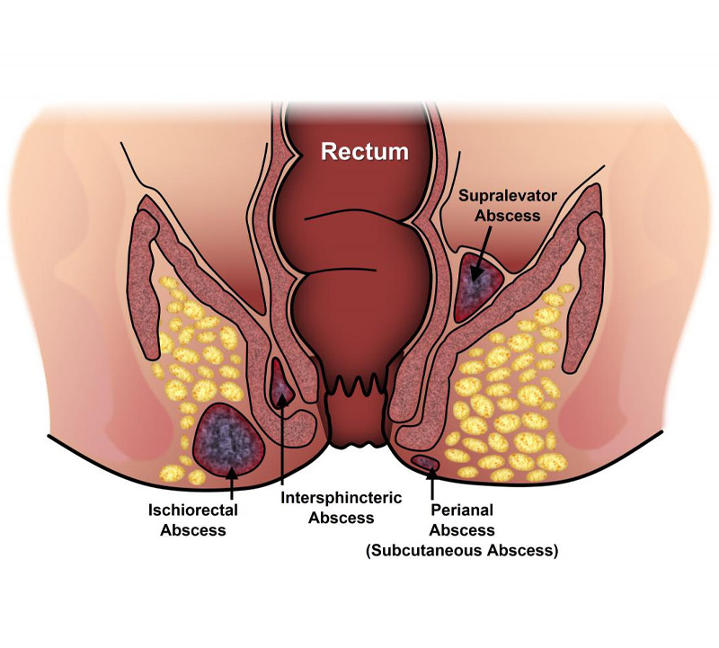 علاج الخراج في المؤخرة بالأدوية