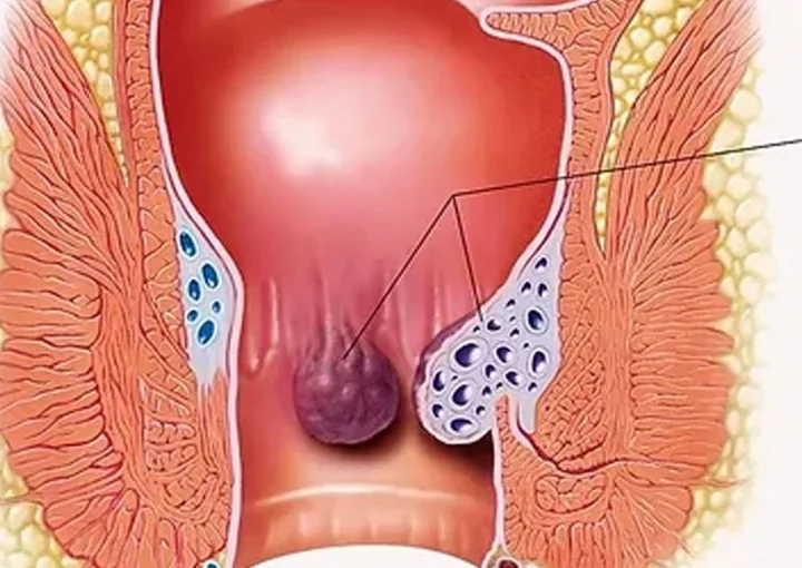 علاج الخراج في المؤخرة
