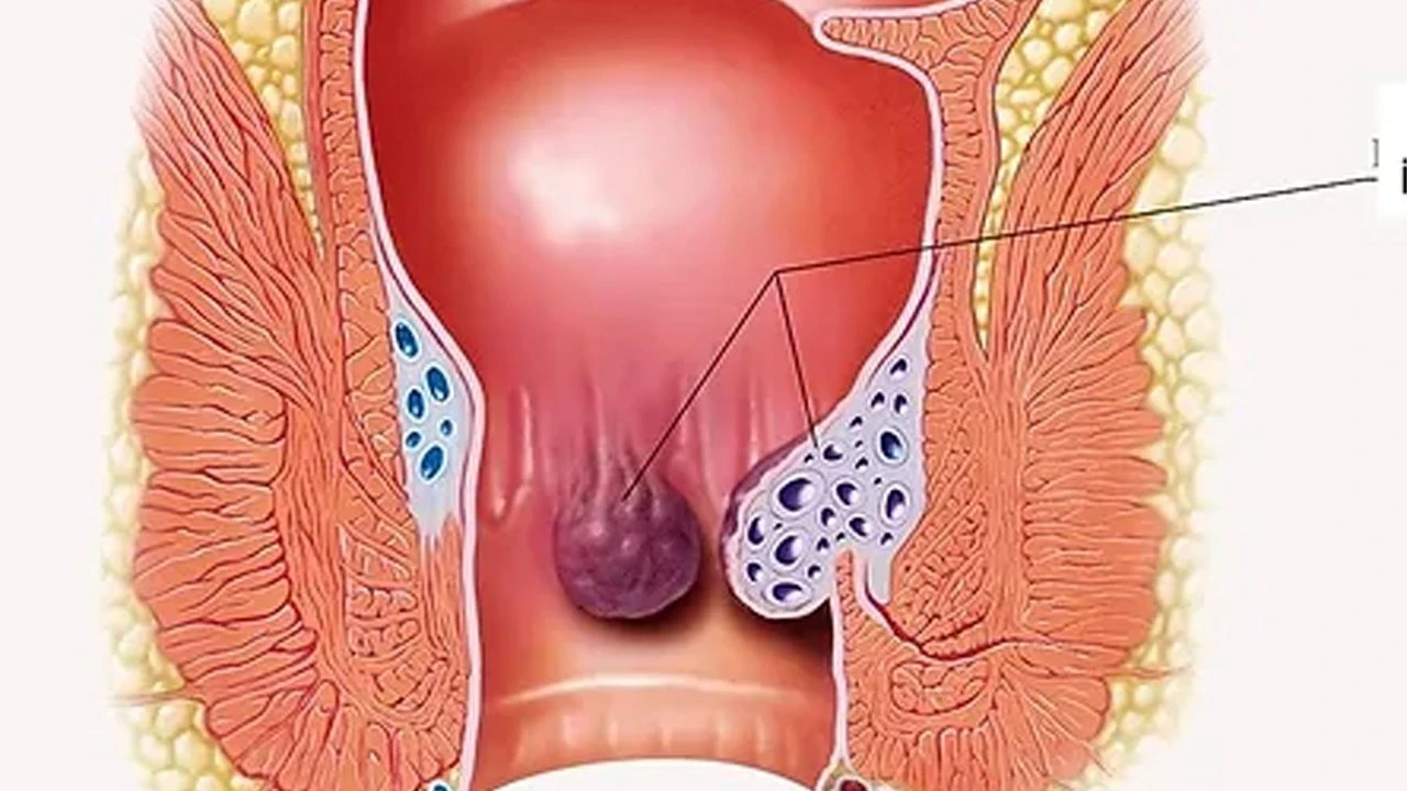 علاج الخراج في المؤخرة