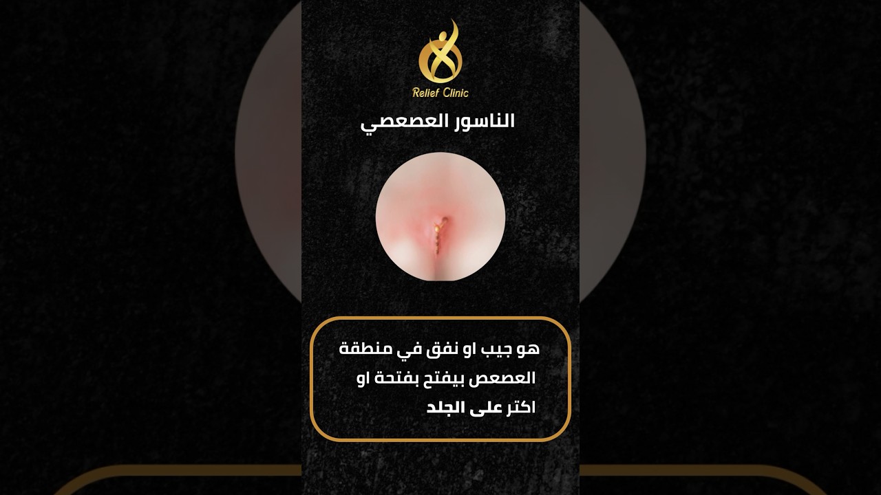 معلومات عن الناسور العصعصي