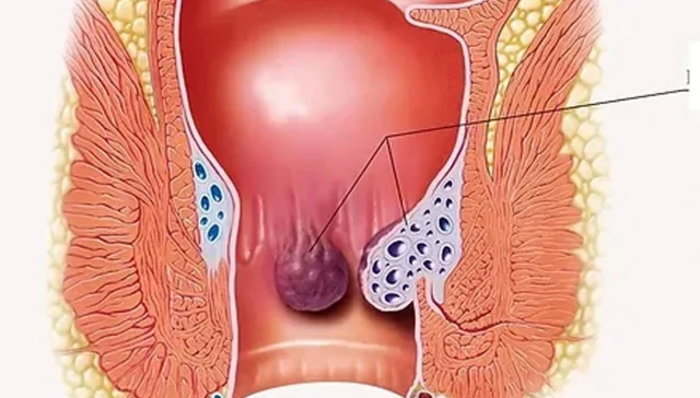 التهاب المستقيم