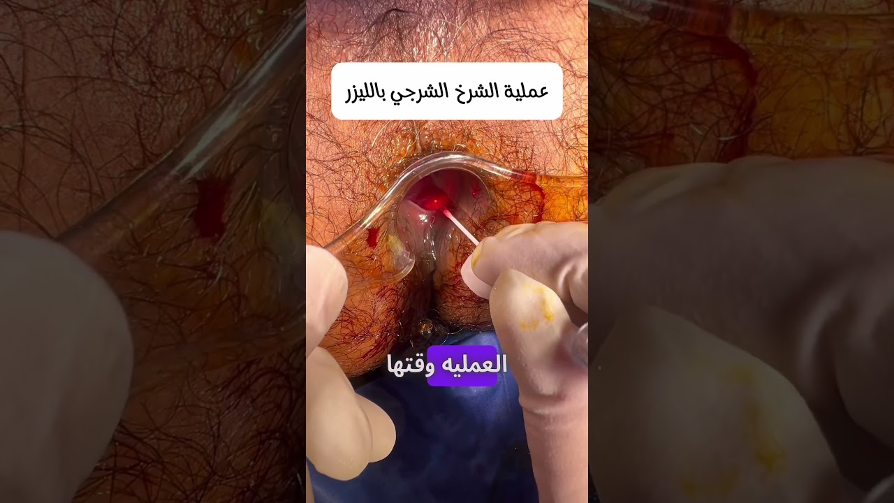 أفضل طريقة لعلاج الشرخ الشرجي بالليزر